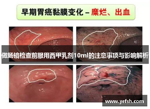 做肠镜检查前服用西甲乳剂10ml的注意事项与影响解析